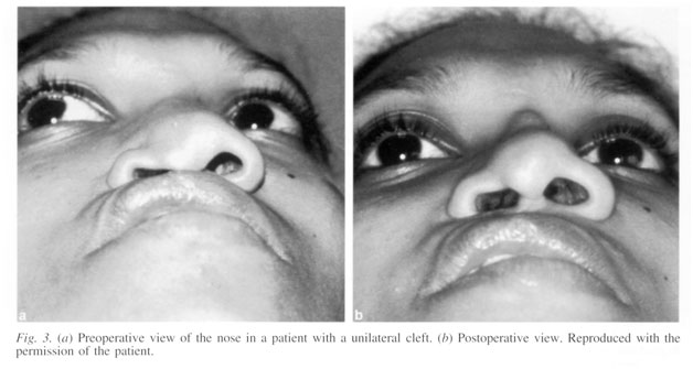 patient with uni-lateral cleft lip