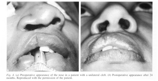 Patient with unilateral cleft