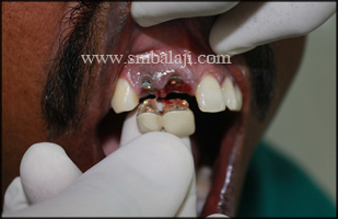 The fractured RCT crown due to failed endodontic treatment removed