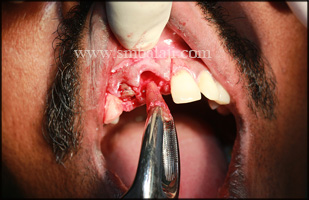 Extraction of the affected tooth root