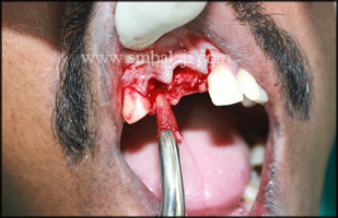 Extraction of the affected tooth root