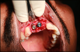 Immediate dental implant fixed into the extraction socket with good stability and retention