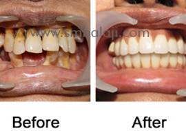  Complete oral rehabilitation with Immediate Implant placement