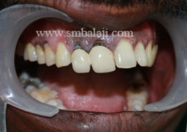 Immediate Dental Implant, balaji Dental, Chennai, India