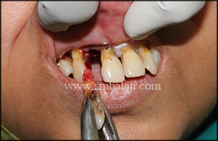 Periodontally weak teeth extracted