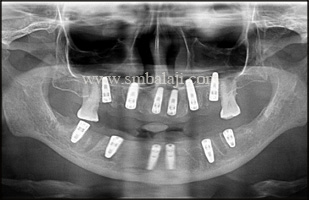 Post operative opg - multiple implants placed with good stability and retention