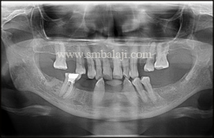 Pre-operative radiograph showing generalized horizontal bone loss