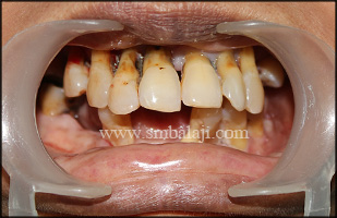 Pre-operative view showing generalized gingival recession