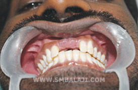 Dental Implant before picture
