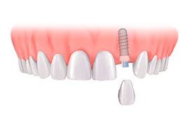 Best Dental Implant in India