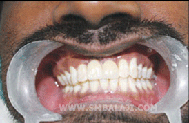 Dental Implant in India