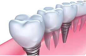 Dental Implant in India
