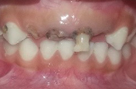 Alignment of crooked, crowded and malaligned teeth