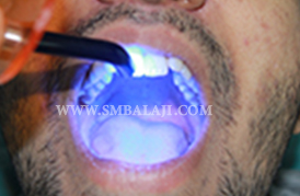 Cosmetic dentistry, Smile designing, Balaji Dental, Chennai