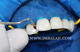 Restorative Dentistry | Management of Decayed Teeth