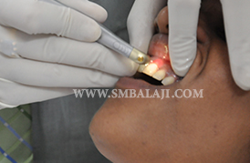 Laser Dentistry, Painless dental Treatment, Balaji Dental, Chennai