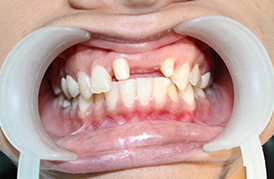 Management of Missing Teeth | Tooth Replacement, Chennai, India