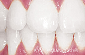 Teeth whitening, Teeth bleaching, Balaji Dental, Chennai