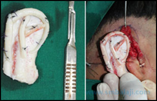 Jaw correction surgery balaji dental