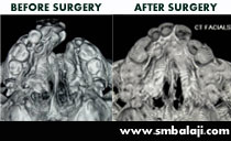 CT scan showing cleft palate defect