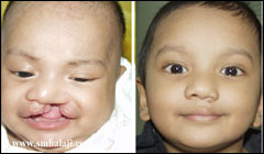 Before and after cleft lip surgery