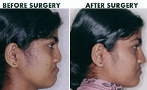 Cleft maxillary advancement Surgery