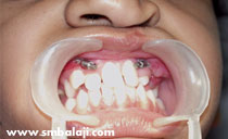 Intraoral distraction after Surgery