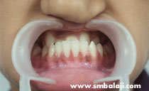 Intraoral distraction before