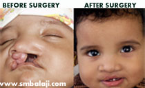 Cleft lip and palate surgery