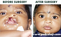 lip surgery in India