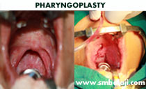 PHARYNGOPLASTY