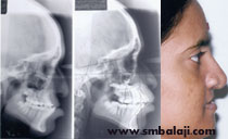 X-rays before and after distraction