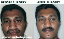 abbe-flap surgery in India.