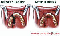 alveolar cleft Surgery in Chennai