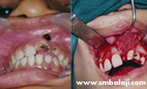 bone graft placed to treat alveolar cleft