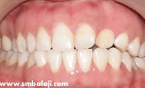 cleft defect healed and teeth aligned
