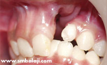 cleft defect in alveolar bone