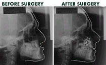 cleft maxillary advancement x-ray