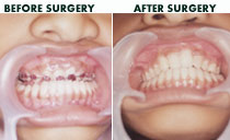 cleft maxillary advancement