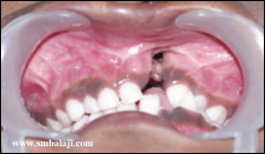Alveolar (tooth-bearing jaw bone) cleft