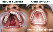 cleft palate Surgeryn India