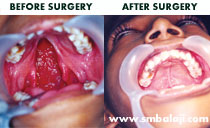 cleft palate surgery in India