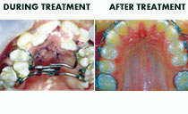 narrow arch with orthodontics