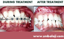 orthodontic alignment of teeth