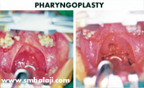 PHARYNGOPLASTY