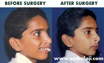 premaxillary setback surgery in Chennai