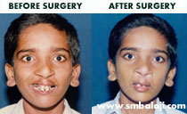 premaxillary setback in India