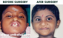 premaxillary setback surgery before after
