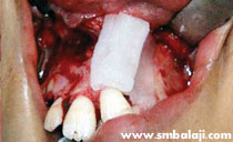 rhBMP-2 placed in alveolar defect avoiding bone graft surgery