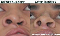 Rhinoplasty Nose correction surgery
